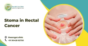 Stoma in Rectal Cancer