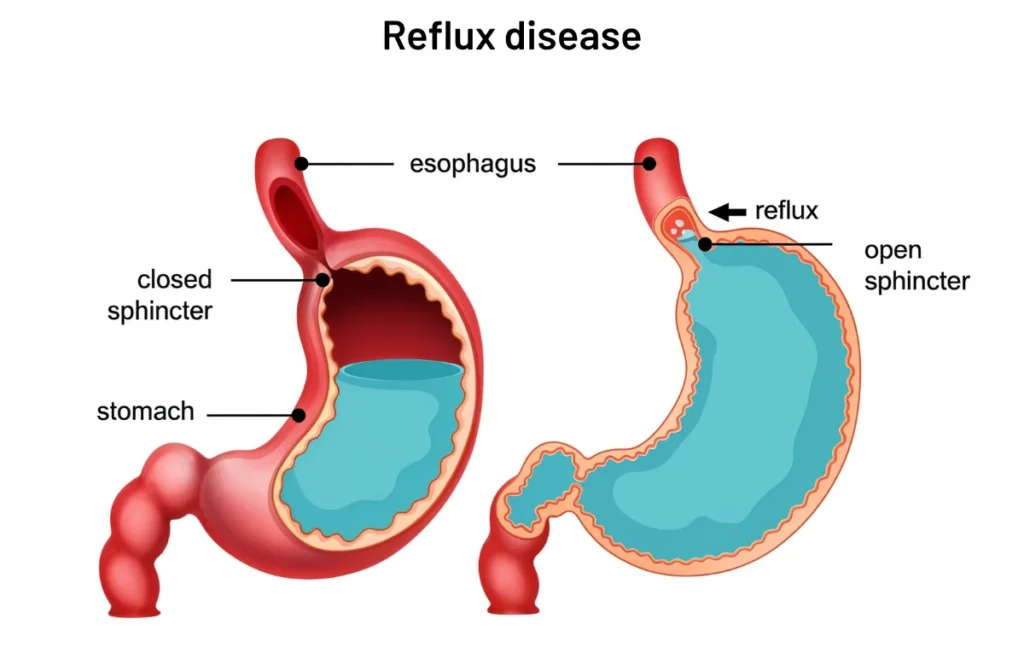 Reflux disease