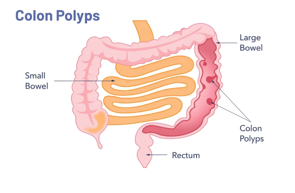 Bowel Cancer Screening