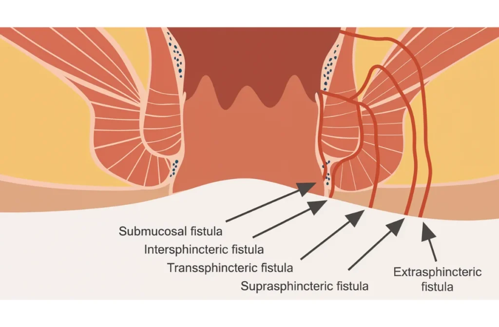 Anorectal Abscess