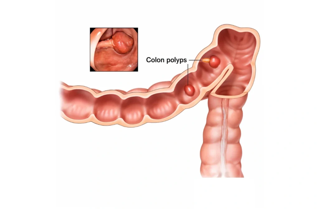 Colonic Polyps

