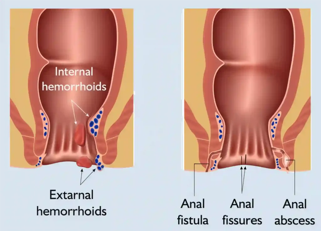 Minimally Invasive Proctology