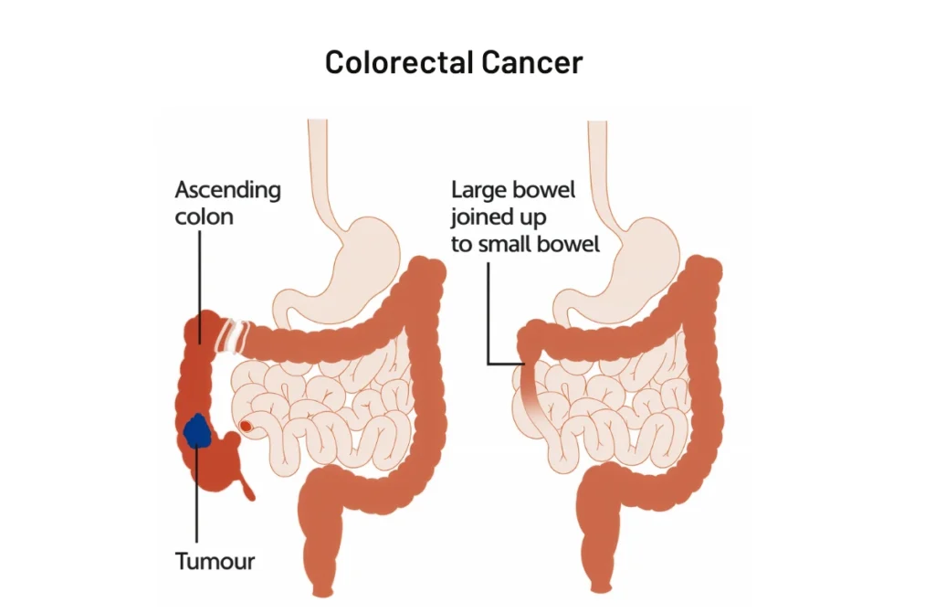 Colorectal Clinic in Chennai