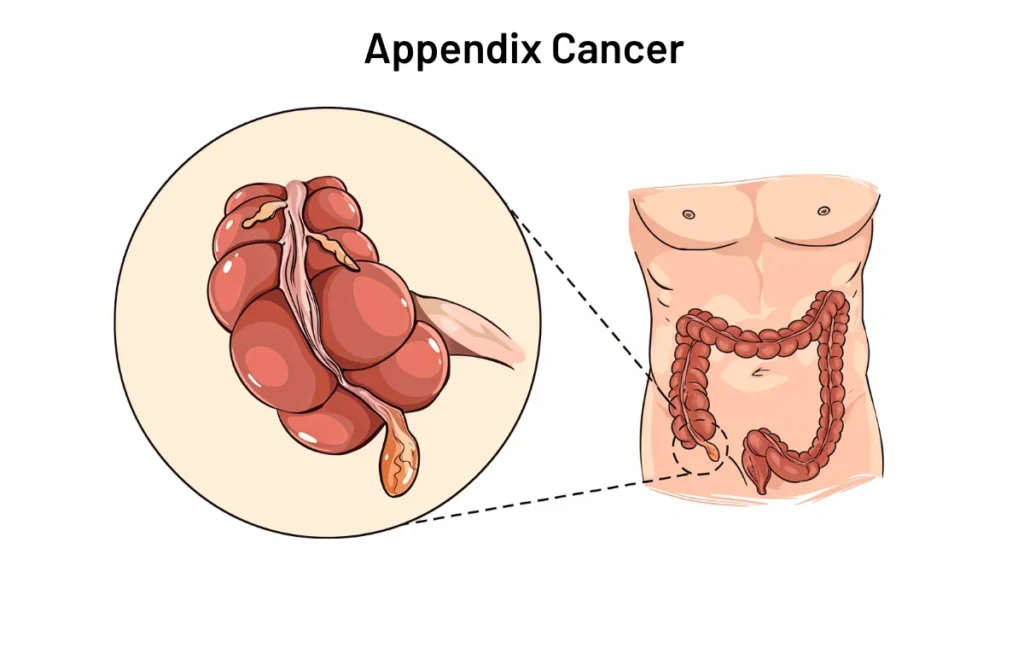 Appendix Cancer