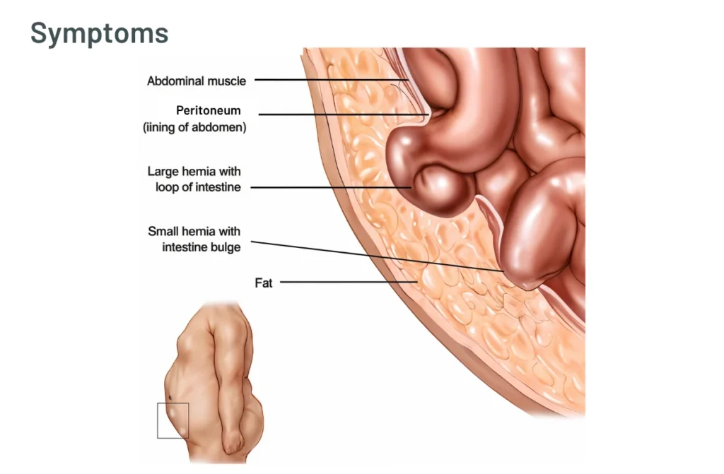 Can a Hernia Heal Itself Without Surgery