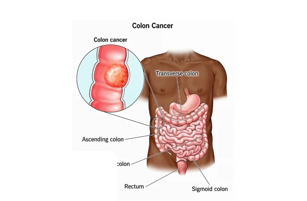 Colon Cancer
