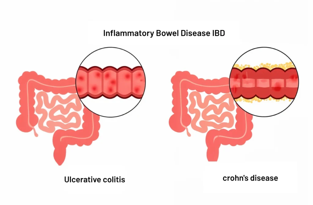 IBD