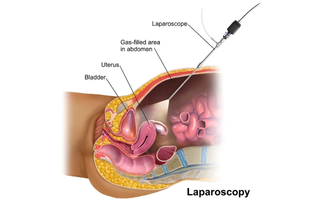 Laparoscopic Surgery