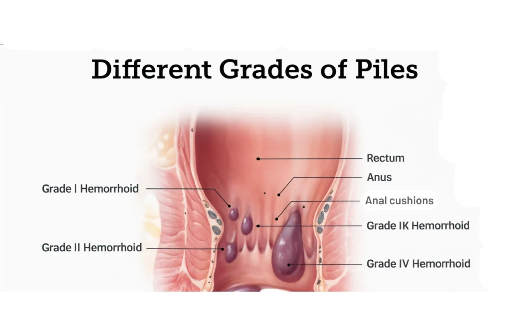 Piles Treatment in Kottivakkam