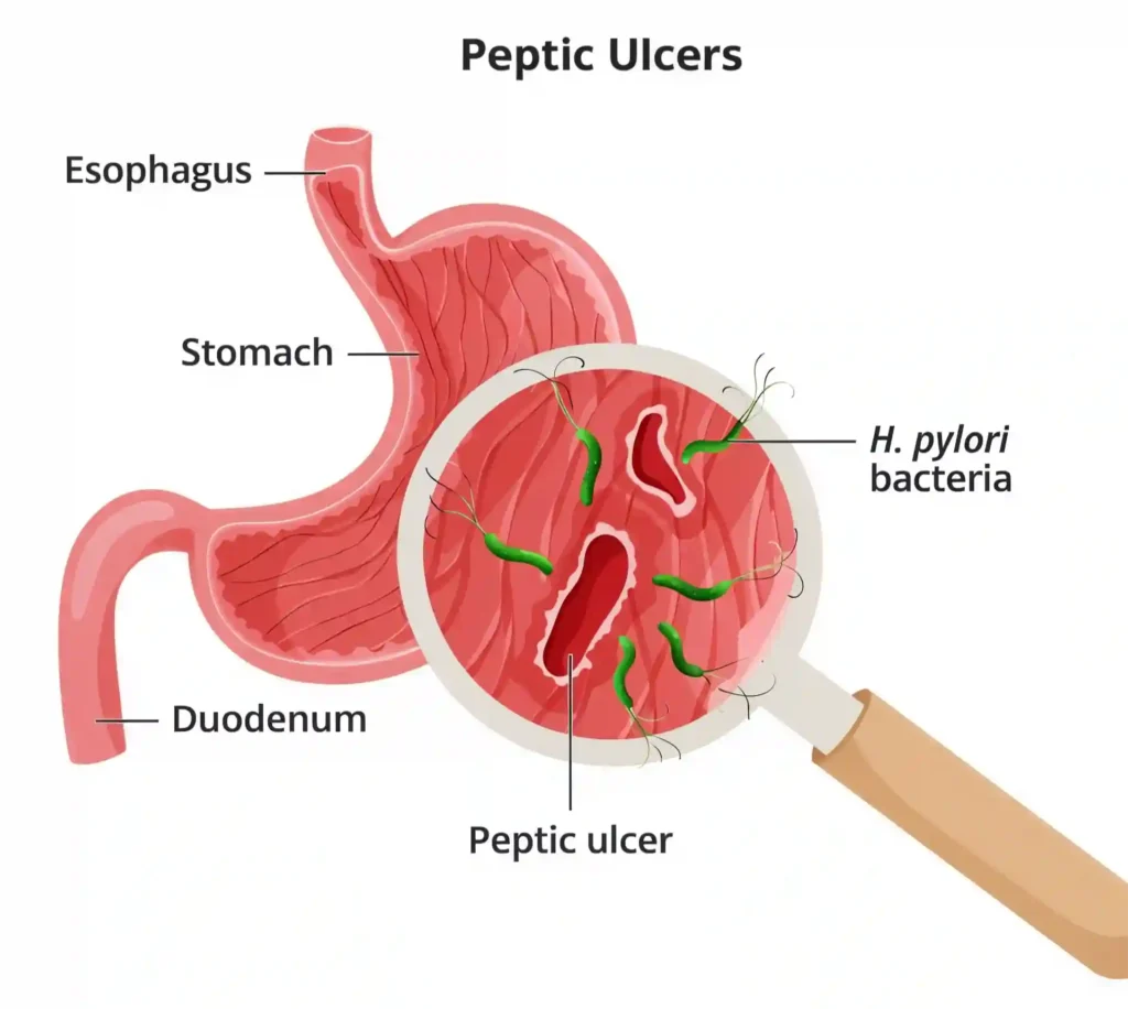 Can Stress Cause Gastric Ulcers?