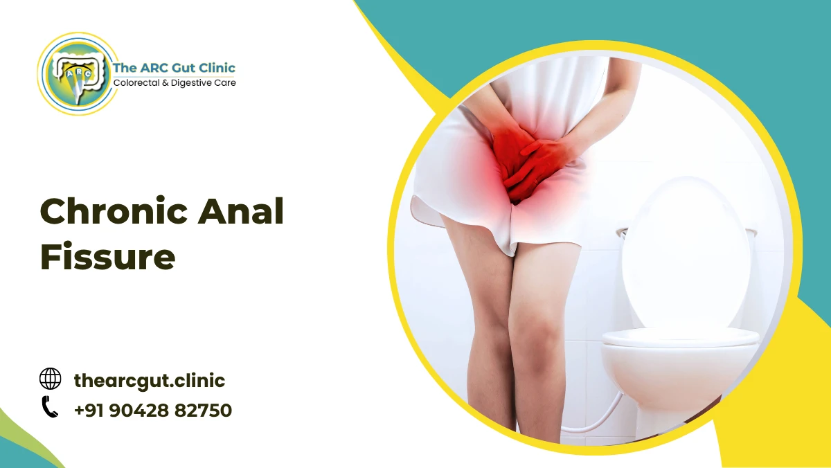 Chronic Anal Fissure