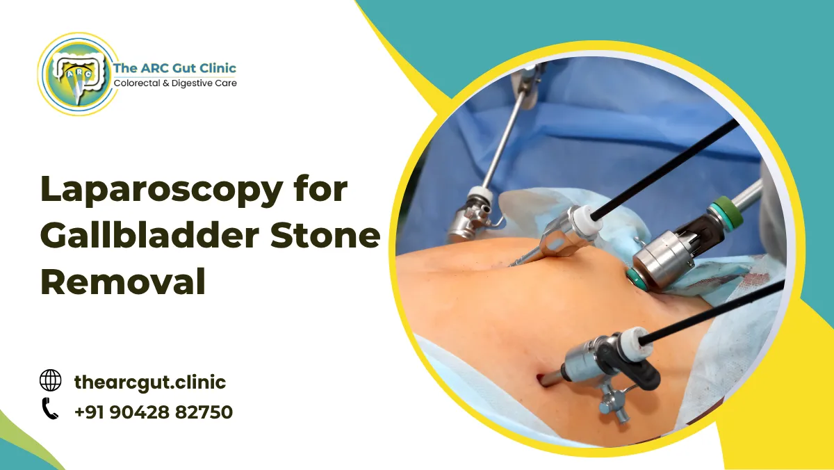 Laparoscopy for Gallbladder Stone Removal