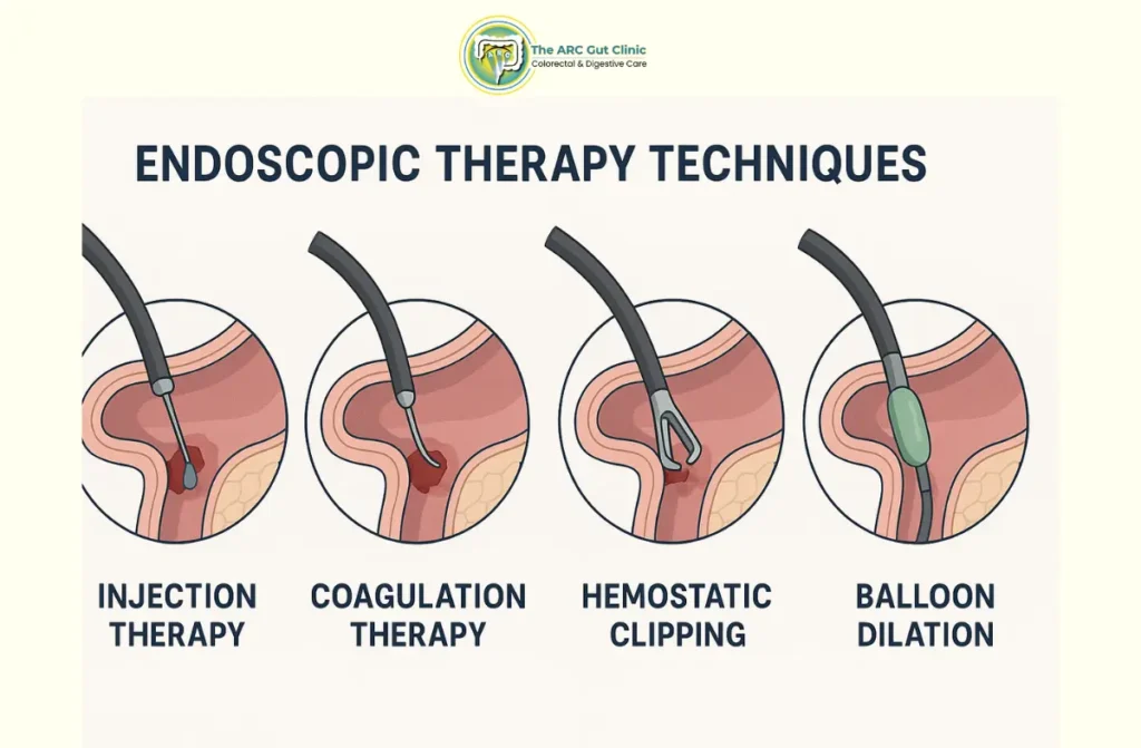 Endoscopic Therapy for Peptic Ulcer Bleeding