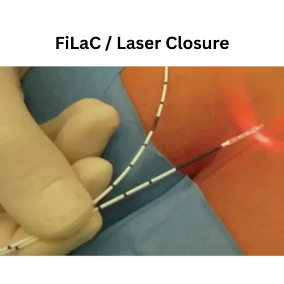 Laser Treatment (FiLaC / Laser Closure) | Best Fistula Specialist in Chennai