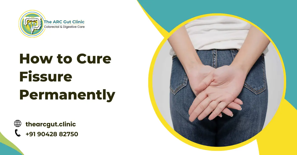 How to Cure Fissure Permanently