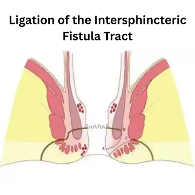 LIFT Procedure (Ligation of the Intersphincteric Fistula Tract) | Best Fistula Specialist in Chennai